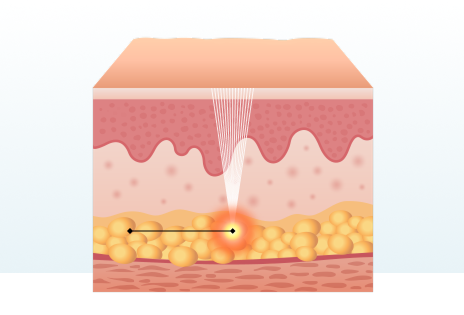 기존 HIFU 시술 특징 이미지